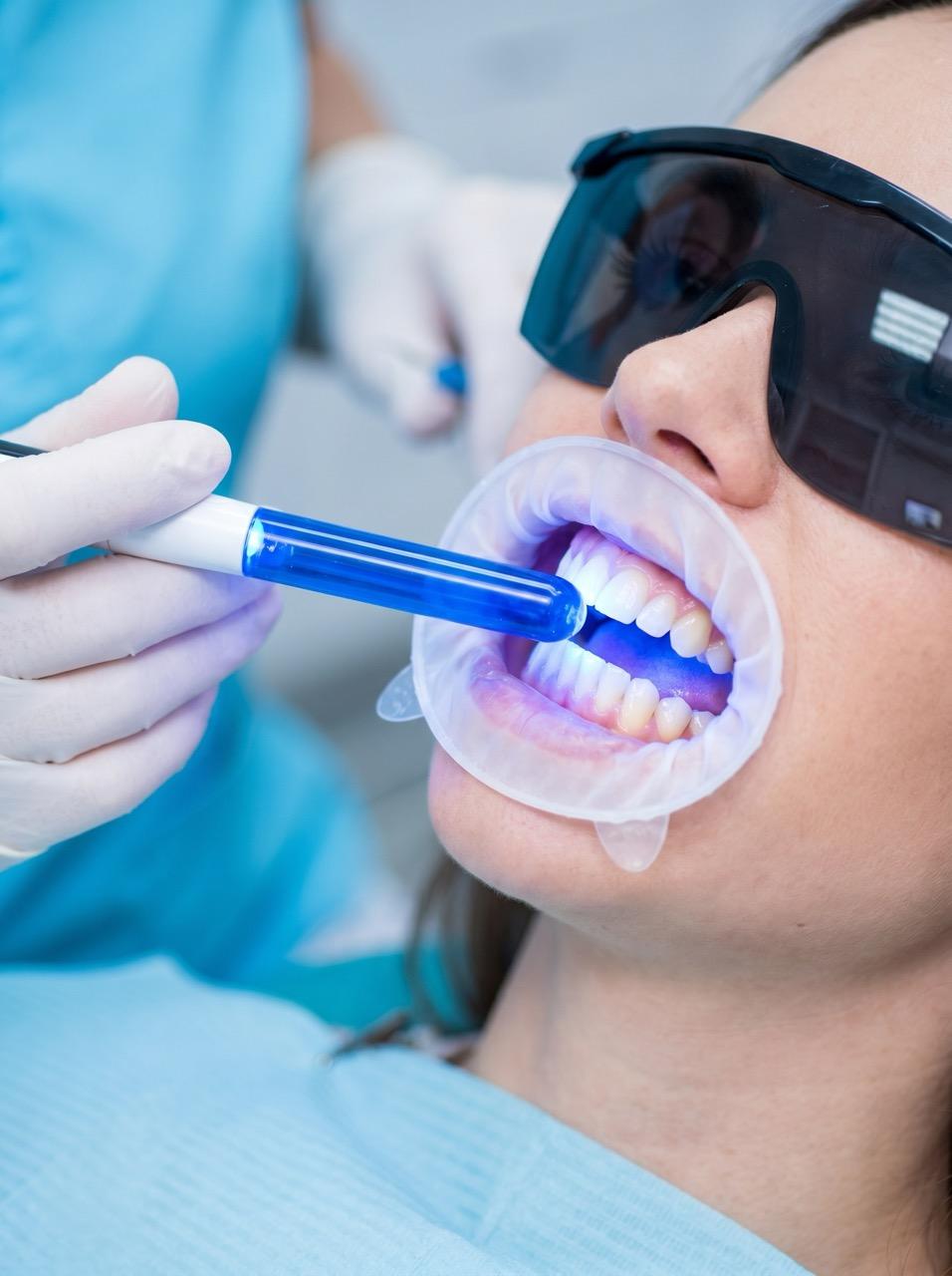 ¿Dientes amarillos? La verdad sobre el blanqueamiento dental en Granada que no te cuentan los "remedios caseros"